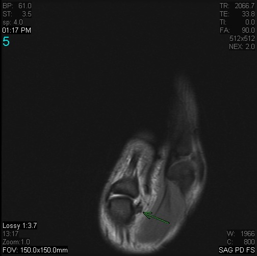 Figure 4 for case Stener lesion